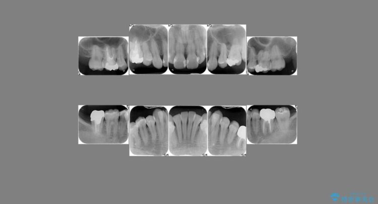 【30代女性】深い虫歯と銀歯をきれいなセラミックに 治療前画像