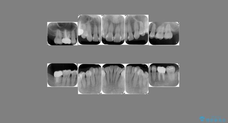 【30代女性】深い虫歯と銀歯をきれいなセラミックに 治療後画像