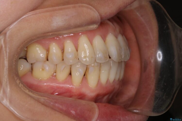 【40代女性】歯ぐき、骨が薄い方のマウスピース矯正治療 治療途中画像