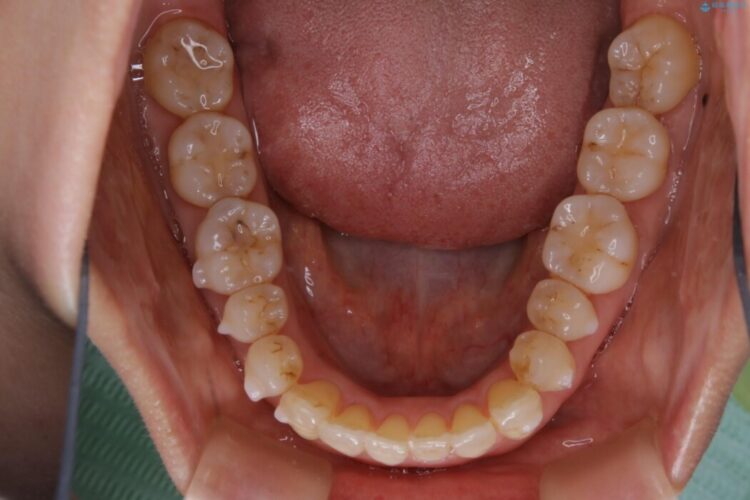【40代女性】歯ぐき、骨が薄い方のマウスピース矯正治療 治療途中画像