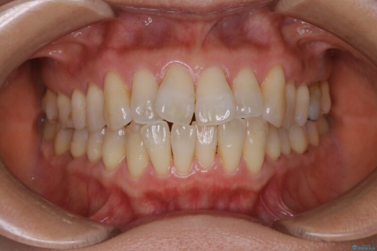 【40代女性】歯ぐき、骨が薄い方のマウスピース矯正治療 ビフォー