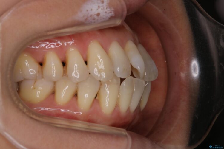 【40代女性】歯ぐき、骨が薄い方のマウスピース矯正治療 治療前画像