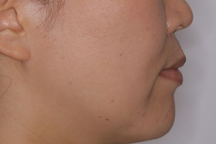 【40代女性】歯ぐき、骨が薄い方のマウスピース矯正治療 治療前画像
