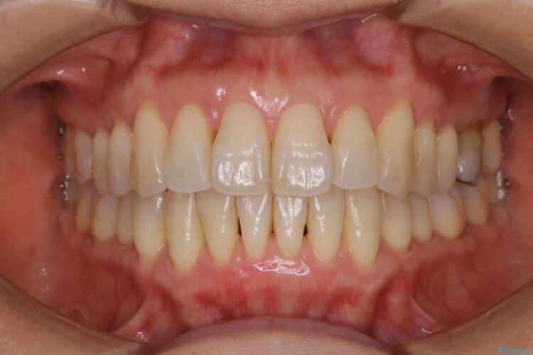 【40代女性】歯ぐき、骨が薄い方のマウスピース矯正治療 アフター
