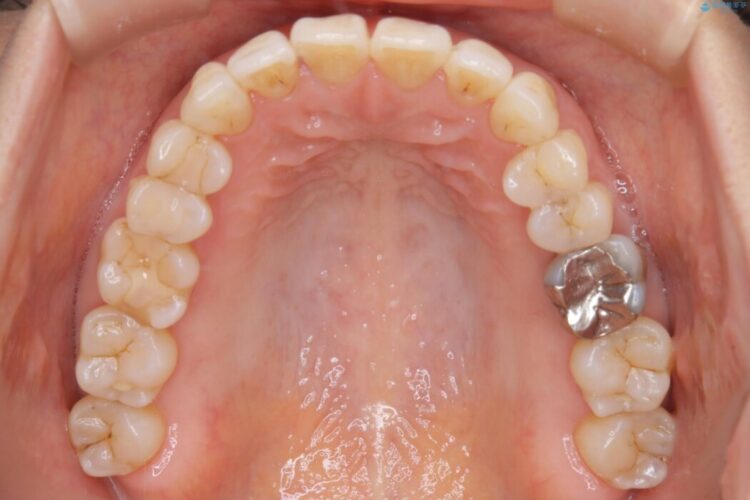 【40代女性】歯ぐき、骨が薄い方のマウスピース矯正治療 治療後画像
