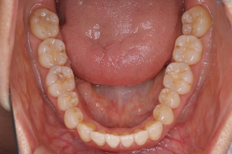 【40代女性】歯ぐき、骨が薄い方のマウスピース矯正治療 治療後画像