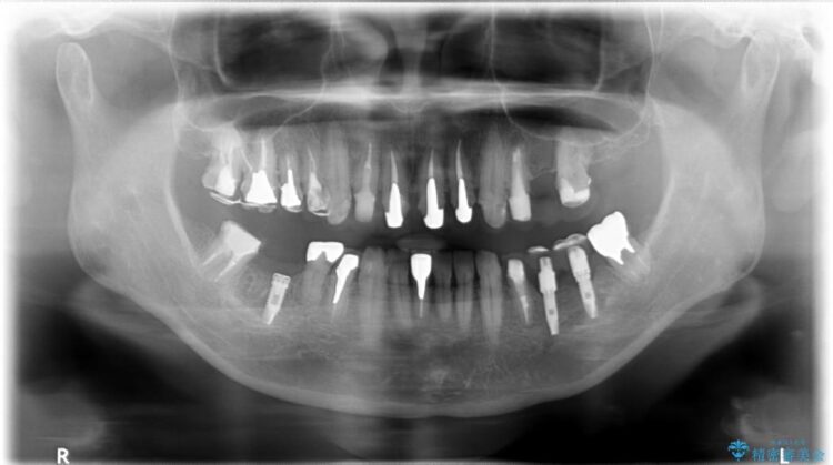 【40代男性】前歯のセラミックと奥歯のインプラント 治療途中画像
