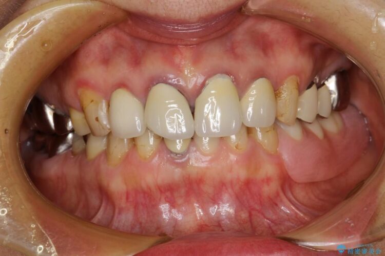 【40代男性】前歯のセラミックと奥歯のインプラント 治療前画像