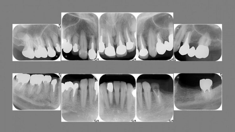 【40代男性】前歯のセラミックと奥歯のインプラント 治療前画像