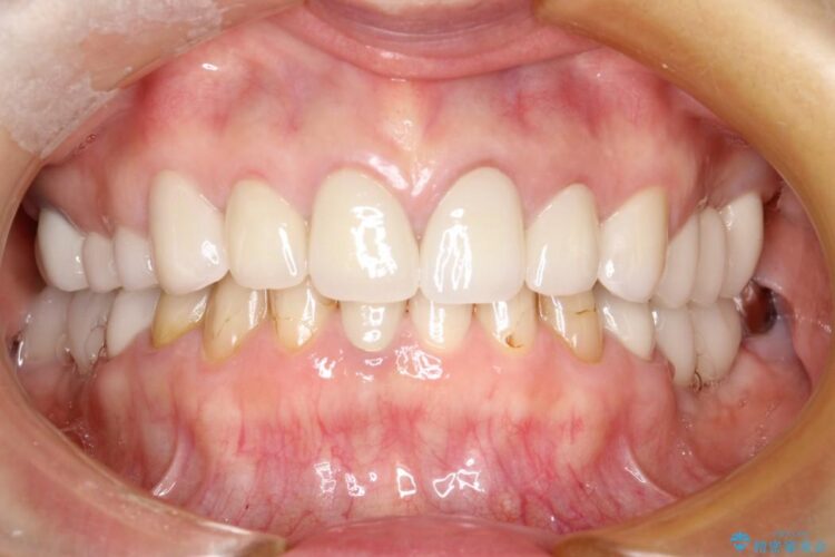 【40代男性】前歯のセラミックと奥歯のインプラント 治療後画像