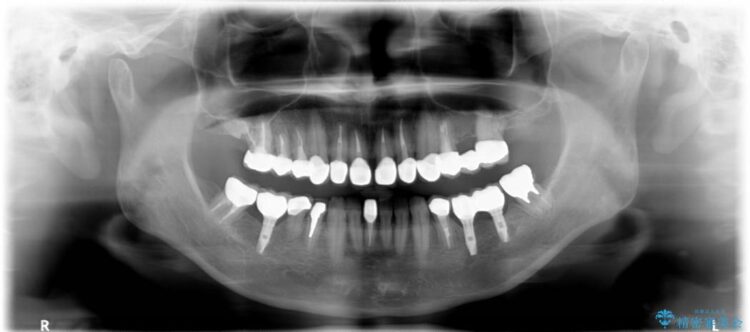 【40代男性】前歯のセラミックと奥歯のインプラント 治療後画像