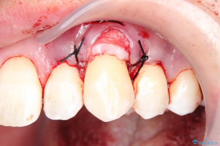 【30代男性】上顎、犬歯の歯茎再生治療 治療途中画像