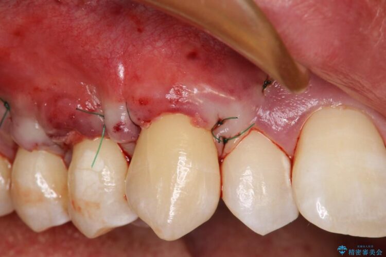【30代男性】上顎、犬歯の歯茎再生治療 治療途中画像