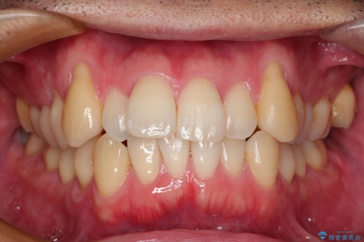 【30代男性】上顎、犬歯の歯茎再生治療 ビフォー