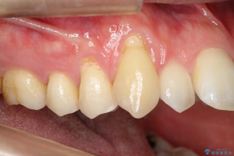 【30代男性】上顎、犬歯の歯茎再生治療 治療前画像