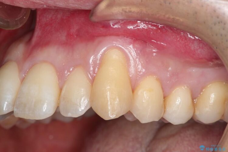 【30代男性】上顎、犬歯の歯茎再生治療 治療前画像