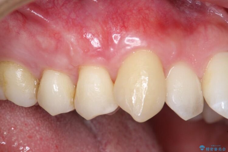 【30代男性】上顎、犬歯の歯茎再生治療 治療後画像