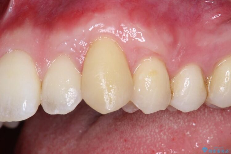 【30代男性】上顎、犬歯の歯茎再生治療 治療後画像