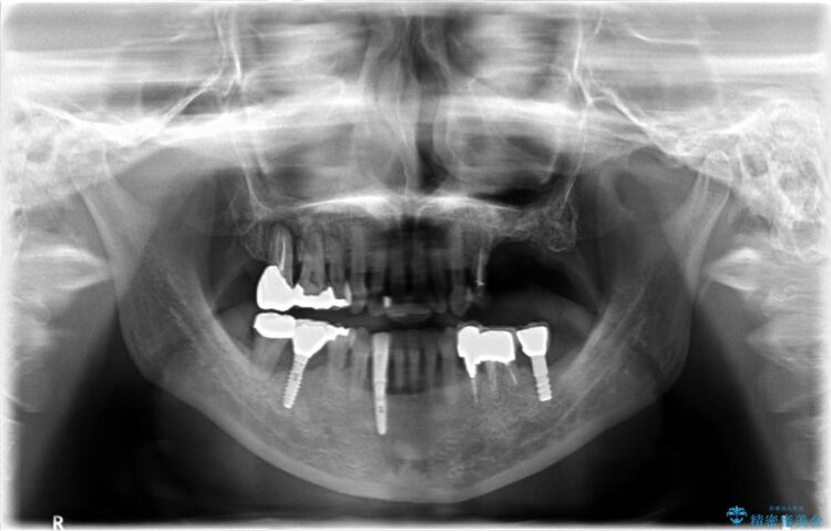 【40代女性】骨の無い上顎のインプラント 治療途中画像