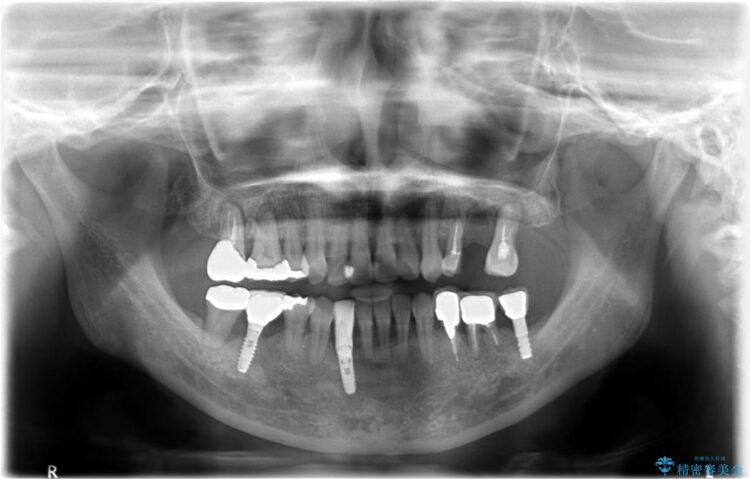 【40代女性】骨の無い上顎のインプラント 治療前画像