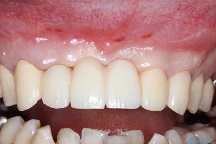 【40代女性】歯茎の再生、ブリッジで前歯の治療 治療途中画像