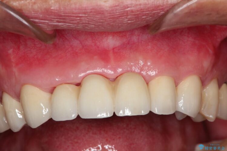 【40代女性】歯茎の再生、ブリッジで前歯の治療 治療後画像