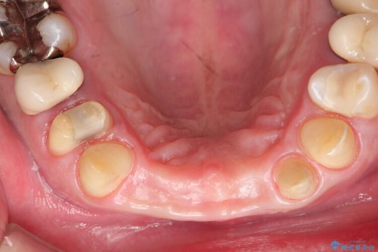 【40代女性】歯茎の再生、ブリッジで前歯の治療 治療後画像