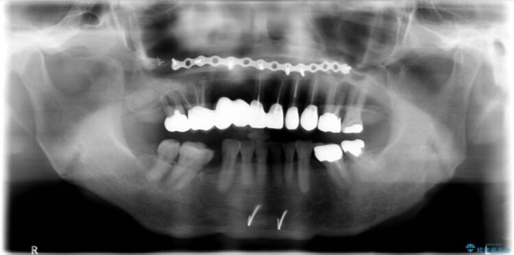 【50代女性】長くなってしまった歯をブリッジで治す 治療途中画像