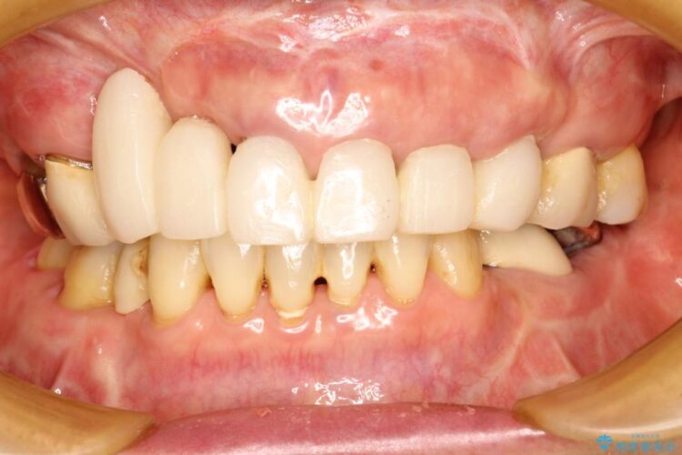 【50代女性】長くなってしまった歯をブリッジで治す 治療前画像