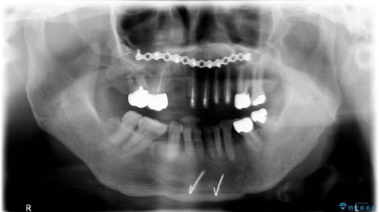 【50代女性】長くなってしまった歯をブリッジで治す 治療前画像