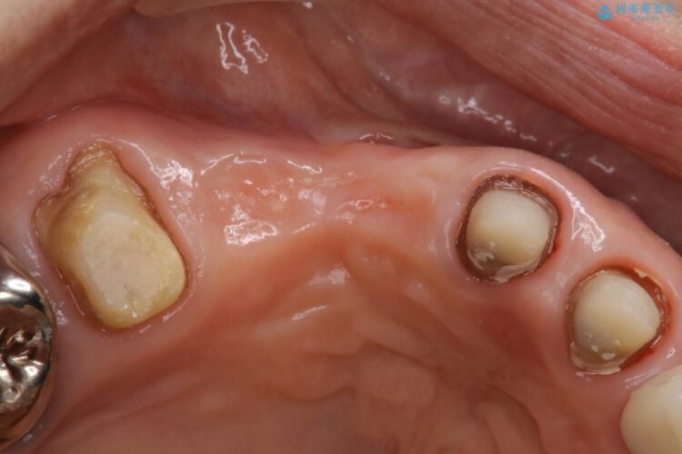 【50代女性】長くなってしまった歯をブリッジで治す 治療後画像