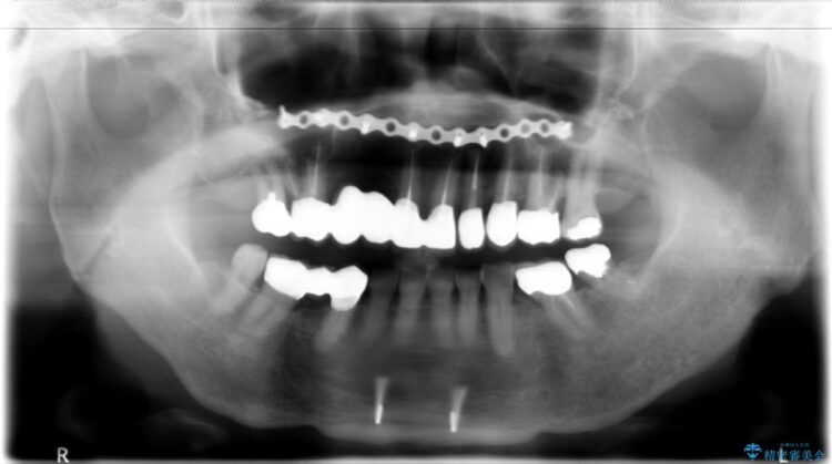 【50代女性】長くなってしまった歯をブリッジで治す 治療後画像