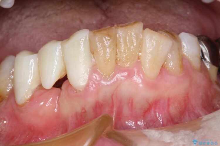 【60代女性】膿が出る、歯茎再生治療 治療途中画像
