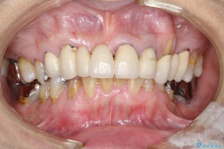 【60代女性】膿が出る、歯茎再生治療 治療前画像