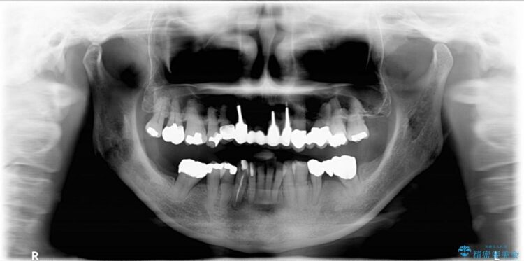 【60代女性】膿が出る、歯茎再生治療 治療前画像