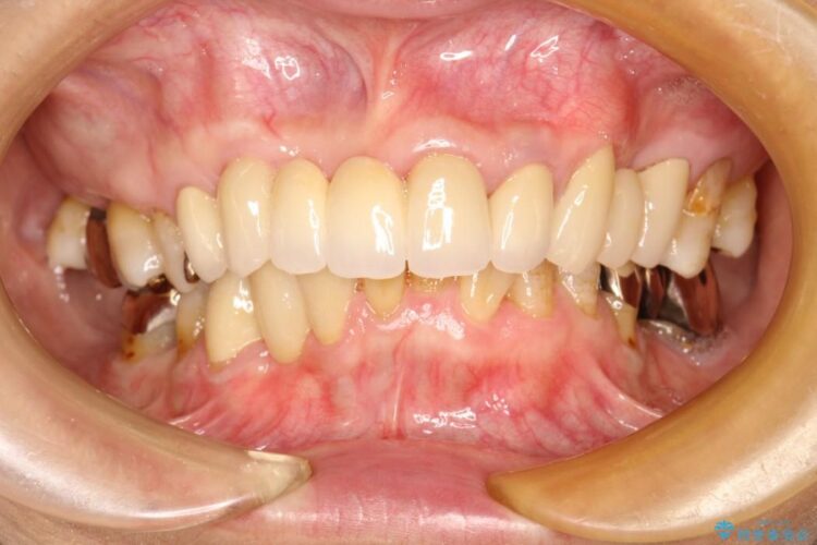 【60代女性】膿が出る、歯茎再生治療 治療後画像
