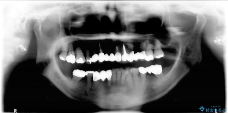 【60代女性】膿が出る、歯茎再生治療 治療後画像