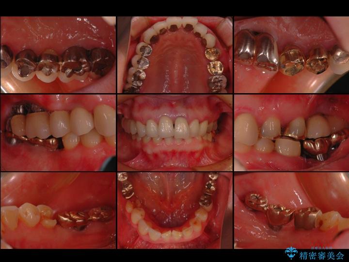 【50代女性】セラミック治療でキレイな歯を取り戻す ビフォー