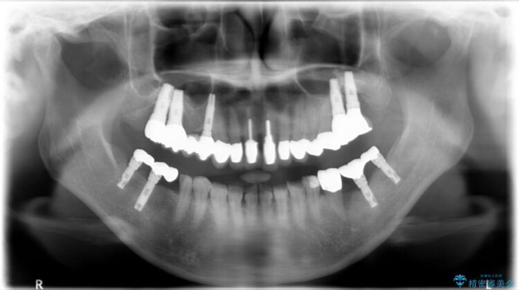 【50代女性】セラミック治療でキレイな歯を取り戻す 治療前画像