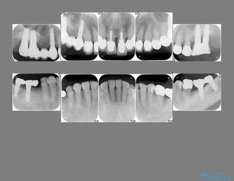 【50代女性】セラミック治療でキレイな歯を取り戻す 治療前画像