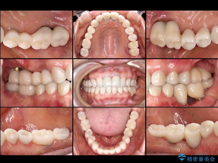 【50代女性】セラミック治療でキレイな歯を取り戻す アフター