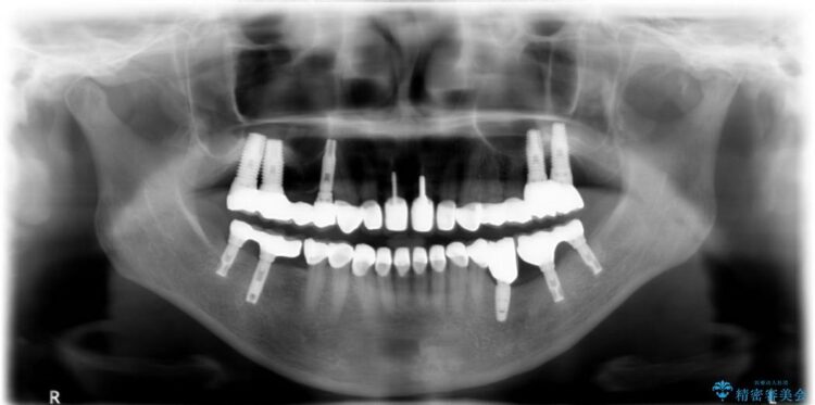 【50代女性】セラミック治療でキレイな歯を取り戻す 治療後画像