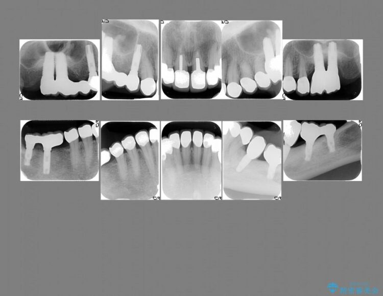 【50代女性】セラミック治療でキレイな歯を取り戻す 治療後画像