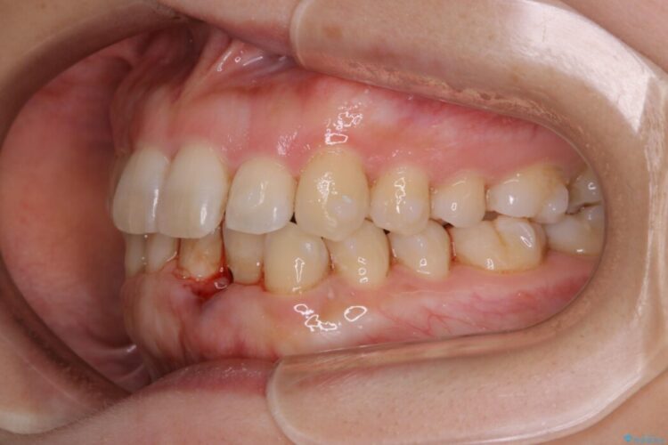 【30代女性】スリーインサイザー仕上げによる抜歯矯正治療 治療途中画像