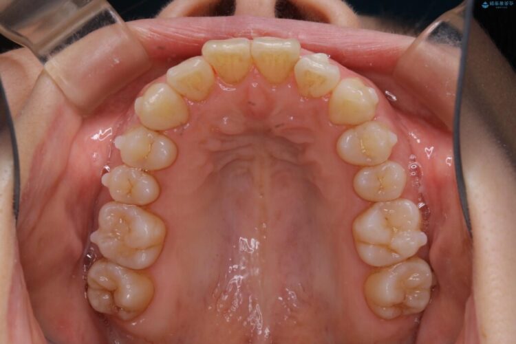 【30代女性】スリーインサイザー仕上げによる抜歯矯正治療 治療途中画像