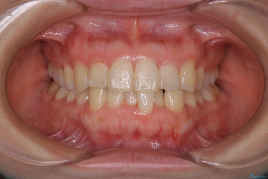 【30代女性】スリーインサイザー仕上げによる抜歯矯正治療 治療前