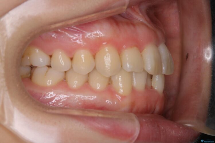 【30代女性】スリーインサイザー仕上げによる抜歯矯正治療 治療前画像