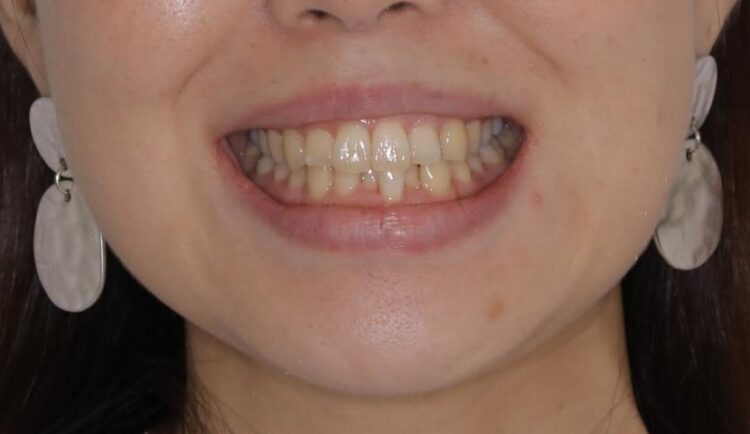 【30代女性】スリーインサイザー仕上げによる抜歯矯正治療 治療前画像