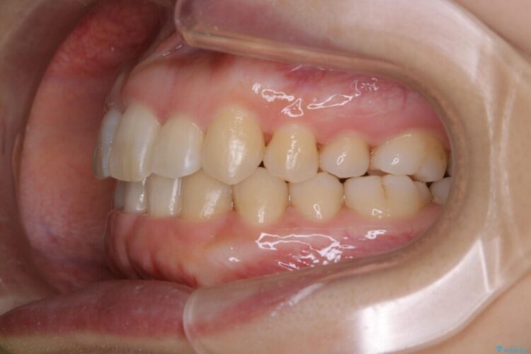 【30代女性】スリーインサイザー仕上げによる抜歯矯正治療 治療後画像