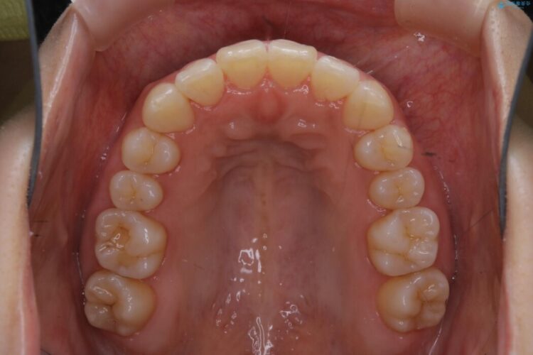 【30代女性】スリーインサイザー仕上げによる抜歯矯正治療 治療後画像